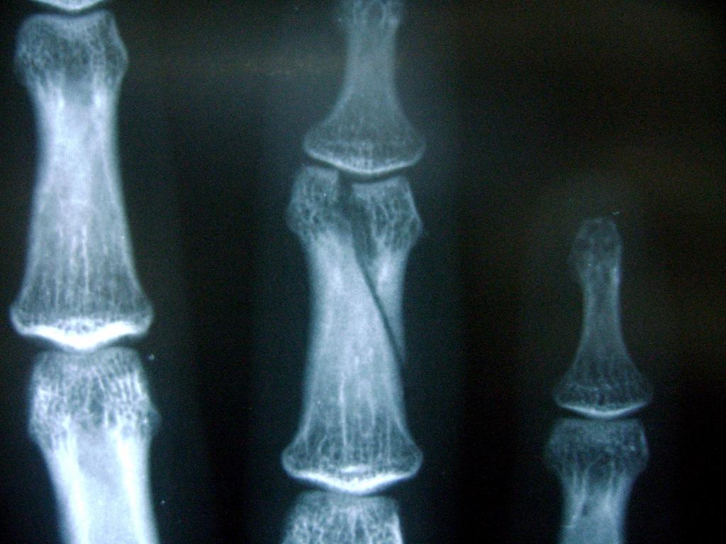 Трещина фаланги. Краевой перелом фаланги рентген. Внутрисуставной перелом фаланги пальца рентген. Краевой перелом ногтевой фаланги рентген. Перелом ногтевой фаланги рентген.